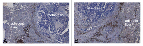 Figure 7. Homogeneity of synchronous hepatic metastases of colorectal carcinoma. (A and B) Overview image (2.5× magnification) of synchronous hepatic metastases of colorectal carcinoma stained for CD3+ cells. In this case, CD3+ cell infiltration in both metastases is comparable.