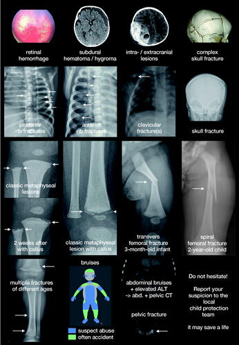 Figure 3. Radiological findings associated with NAI. While some findings are highly specific for NAI, the less specific findings are common in both NAI and accidents. Thus, we refrained from subdivision as any of these findings without an appropriate accident should result in involvement of a child protection team.