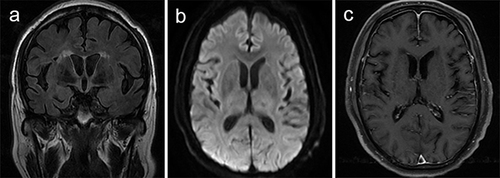 Figure 6 Brain magnetic resonance imaging of patient 8. Brain magnetic resonance imaging performed 18 days after clinical onset showed abnormal signal of bilateral lateral ventricles (a and b) and leptomeningeal enhancement (c).