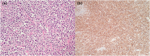 Figure 1 (a) Tumor cells are arranged in a sheet, diffuse infiltration and growth. HE stain. X20. (b) Most of the infiltrating lymphoid cells show positive Immunoreactivity staining for CD20. Immunohistochemical stain. X20.