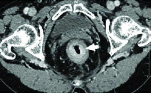 Figure 7 Computed tomography scan of 59-year-old woman with signet-ring cell carcinoma of the rectum.