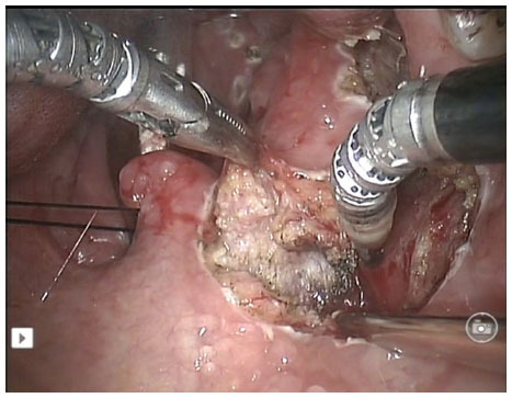 Figure 3 Screen capture of the robotic radical right tonsillectomy showing division of the superior constrictor muscles with the monopolar cautery diathermy spatula.