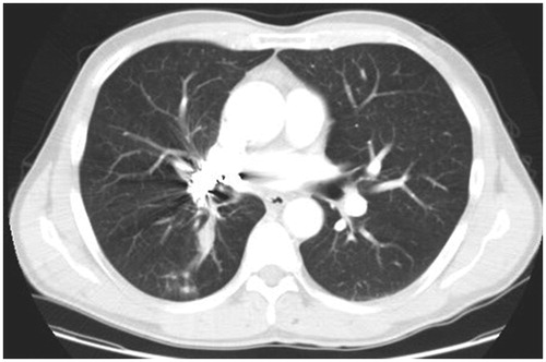 Figure 4. Thoracic CT scan image in 2009. A follow-up contrast-enhanced CT image with soft-tissue window after 2 months of treatment with second-line chemotherapy showing an increased tumour in the right lung.
