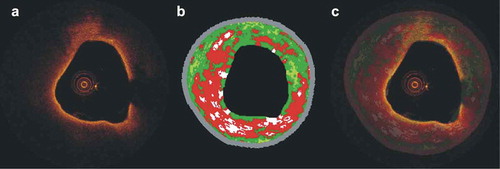 Figure 1. Efficacy of combined OCT – IVUS-VH imaging in assessing plaque morphology. (a) OCT frame showing a lipid-rich plaque with a thin fibrous cap. The corresponding IVUS-VH frame is shown in panel (b). Fusion of these images enables complete assessment of plaque characteristics: OCT allows evaluation of plaque composition and fibrous cap thickness while IVUS-VH provides quantitative information about plaque composition, quantification of plaque burden and estimation of the remodeling pattern (c).