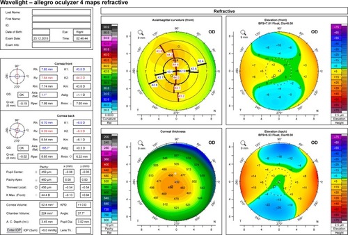 Figure 1 Preoperative corneal tomography of a patient seeking refractive correction for −2.50 D. Corneal tomography demonstrates a reduced pachymetry with no other abnormalities. The patient underwent PRK combined with CXL.