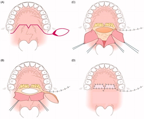 Figure 5. Illustration of Figure 4(A–D). A: The basal portion of the left BMMF is denuded (red area).