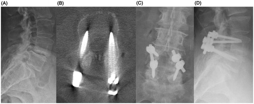 Figure 3 A. Preoperative lateral radiograph demonstrating degenerative L4-L5 spondylolisthesis. B. Intraoperative 3D cone-beam CT demonstrating ideal screw placement. C. Post-operative AP radiograph. D. Post-operative lateral radiograph.