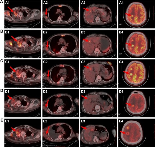 Figure 3 The dynamic evolution of the patient’s primary and metastases tumors during the treatment in the PET-CT images. (A) Images A1–A4 were taken at the first clinic visit on August 10, 2015. The right upper chest mass was 51×41 mm, with a the maximum of standardized uptake value (SUVmax) of 5.6, MTV value of 28.8, and TLG value of 105 (A1). The right subscapularis muscle mass was 27×12 mm, with a SUVmax of 4.9, MTV value of 2.1, and TLG value of 6.4 (A2). The liver mass was 12×11 mm, with a SUVmax of 6.2, MTV value of 2, and TLG value of 8.2 (A3). The larger mass in the occipital lobe of the brain mass was 26×17 mm (A4). (B) Images B1–B4 as baseline were taken after the methylprednisolone on September 10, 2015. The right upper chest mass was 53×52 mm, with a maximum SUV value of 7.2, MTV value of 39.9, and TLG value of 174 (B1). The right subscapularis muscle mass was 27×17 mm, with a SUVmax value of 4.8, MTV value of 5.2, and TLG value of 15.5 (B2). The liver mass was 12×11 mm, with a SUVmax value of 6.7, MTV value of 4, and TLG value of 15.4 (B3). The brain mass was 27×18 (B4). (C) Images C1–C4 were taken after 1 month treatment of oral crizotinib on October 9, 2015. The size of the tumor seemed to be stable. The right upper chest mass was 44×38 mm, with a maximum SUV value of 8, MTV value of 14.2, and TLG value of 24.9 (C1). The right subscapularis muscle mass was 27×17 mm, with a SUVmax value of 2.9, MTV value of 4.8, and TLG value of 11.3 (C2). The liver mass was 18×14 mm, with a SUVmax value of 4, MTV value of 2.2, and TLG value of 6.8 (C3). The brain mass was 27×18 mm (C4). (D) Images D1–D4 were taken on December 10, 2015, after 3 months of oral crizotinib, and there was progressive disease in the brain. The right upper chest mass was 46×43 mm, with a maximum SUV value of 3.6, MTV value of 28.5, and TLG value of 72.5 (D1). The right subscapularis muscle mass was 28×16 mm, with a SUVmax value of 2.9, MTV value of 9, and TLG value of 15.5 (D2). The liver mass was 13×8 mm, with a SUVmax value of 1.7, MTV value of 11, and TLG value of 14.1 (D3). The brain mass was 28×18 mm (D4). (E) Images E1–E4 were taken on February 2, 2016, after two cycles of bevacizumab with oral crizotinib, and all tumors were increased in bulk. The right upper chest mass was 60×56 mm, with a maximum SUV value of 3, MTV value of 88.4, and TLG value of 168.6 (E1). The right subscapularis muscle mass was 42×34 mm, with a SUVmax value of 2.4, MTV value of 49.8, and TLG value of 73.4 (E2). The liver mass was 17×13 mm, with a SUVmax value of 3.5, MTV value of 13.1, and TLG value of 25.2 (E3). The brain mass was 30×19 mm (E4). The change of the tumor of the right chest wall (A1–E1). The change of the right upper arm muscle space (A2–E2). The change of the liver (A3–E3). The change of the brain (A4–E4).