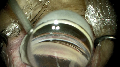 Figure 1 Intraoperative findings determined by the Kahook Dual Blade. The Kahook Dual Blade was inserted into the anterior chamber through the corneal port at the temporal position.