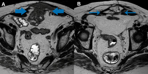 Figure 1 Magnetic resonance images showing a large incisional hernia with the presence of bowel (A, arrows) and omentum (B, arrows).