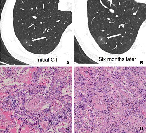Figure 2 A 52-year-old man with a nonabsorbable inflammatory nodule. (A) CT image shows a part-solid ground glass opacity nodule with regular shape, ill-defined margin, and target sign in the right lower lobe (white long arrow); (B) CT images show a persistent nodule after six months follow-up CT (white long arrow); (C) photomicrograph shows that GGO corresponds to slightly interstitial fibrous tissue hyperplasia with inflammatory cell infiltration and with serous exudation in the alveolar space (hematoxylin-eosin stain, original magnification, ×100); (D) photomicrograph shows that the solid component corresponds to interstitial fiber hyperplasia with inflammatory cell infiltration (hematoxylin-eosin stain, original magnification, ×100).