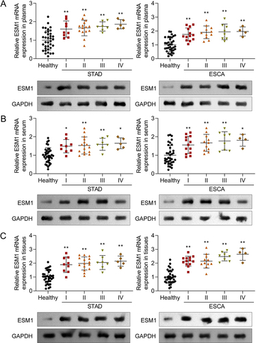 Figure 4 ESM1 showed an upregulated mRNA and protein levels in STAD and ESCA. The mRNA and protein levels of ESM1 in each group in (A) plasma, (B) serum, and (C) tissues were detected by RT-qPCR and Western blot. (*p<0.05; **p<0.01).