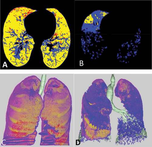 Figure 1. Mild versus marked CT analysis of two cases in our study. A&C) axial colored CT image and 3D image analysis of the lung revealed mild ground glass percentage (20%) in blue color. B&D) axial colored CT image and 3D image analysis of the lung revealed marked ground glass percentage (77%) in blue color.