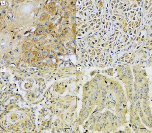 Figure 4. Immunohistochemistry staining of cPD-L1-positive tissues of clone 5D2. (A) 100% of neoplastic cells in squamous cell carcinoma, (B) oral malignant melanoma, (C) soft tissue sarcoma, and (D) tubular mammary carcinoma presents strong membranous and cytoplasmic staining for cPD-L1 (400×). IHC. Bar = 10 µm.