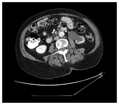 Figure 3 Abdominal and pelvic CT scan revealing a left hydronephrosis with renal cortical atrophy and an obstructing mass at the iliac crossing of the left ureter.Abbreviation: CT, computed tomography.