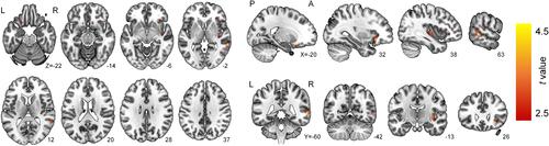 Figure 1 Brain regions that showed lower absolute cerebral blood flow in the FF group than in the control group are displayed in the axial, sagittal and coronal sections. Whole brain voxel-wise analyses were performed after adjusting for age and global mean cerebral blood flow of the grey matter. The color bar represents voxel-level t values. The numbers below the brain slices indicate z, x, y coordinates in the Montreal Neurological Institute space.