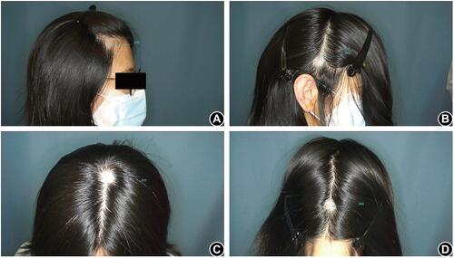 Figure 1 Measuring points of trichoscopy in frontal (A), parietal (B), vertex (C), and occipital (D) areas.