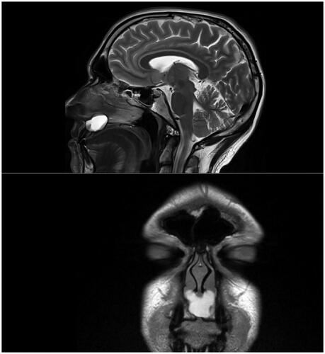 Figure 1. (A and B) MRI imaging of the patient highlighting a high-intensity signal in the maxillary region on the T2 sagittal view (A) that has a bi-lobed ‘Mickey Mouse’ appearance on a coronal view (B).