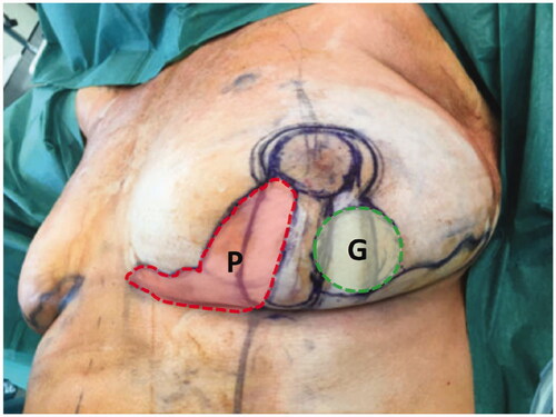 Figure 2. Intraoperative surgical markings on the left index breast outlining a round neoareola (shaded green, marked G) of the inferolaterally-based Grisotti flap and the location of the inferomedial secondary pedicle with its overlying skin (shaded red, marked P) prior to de-epithelialisation. The Wise pattern (deep black markings) is superimposed on these markings.