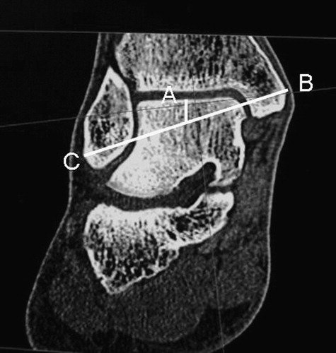 Figure 2. Example of CT image with the center of the ankle and the medial/lateral malleolar axis inserted (diagrammatic). A = anatomically defined center of ankle joint; B = most medial point; C = most lateral point.