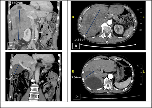 Figure 3 Imaging studies before and after ICI therapy. (A and B) A huge conglomerate tumor (18x14x10 cm) at the right inferior lobe of liver with obliteration of right portal vein. (C and D) The tumor reduced to 9.44×5.66 cm in size after 17 cycles of Atezo/Bev, and the right portal vein tumor thrombus (PVTT) also regressed.