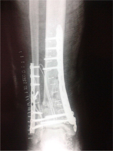Fig. 2 Postoperative anteroposterior lower extremity radiograph showing the internal fixation of the pilon fracture.