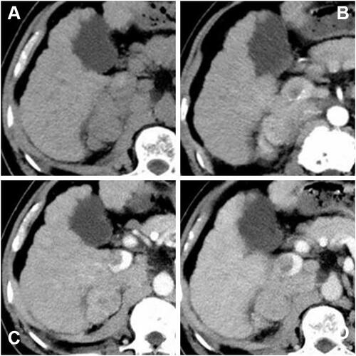 Figure 2 Contrast-enhanced computed tomography (CECT) scan showed that an irregular tumor mass located in segment V of the right lobe of the liver with renal vein and inferior vena cava involved. The tumor had enhancement in the arterial phase and was washed out in the venous phase. ((A) precontrast scan, (B) arterial phase, (C) portal phase, (D) delayed phase).