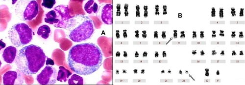 Figure 1 Bone marrow aspirate (1000×) using wright stain and chromosome study on first admission. (A) A BM study revealed acute myeloid leukemia. (B) A chromosome study revealed a karyotype of 46, XY, t(9; 22)(q34; q11) in all 20 cells analyzed.