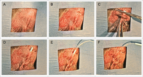 Figure 4. Photographic overview of the subcutaneous, DL transplant procedure implementing 6-Fr. nylon catheter. (A) Angiocatheter implanted under skin 4 weeks prior to transplant. (B) Small incision made cranial to catheter. (C) Small section of implanted catheter is cut to expose vascularized tissue scaffold. (D) Catheter is exposed through superficial incision. (E) PE-50 tubing containing islet preparation inserted into the lumen of 6-Fr. (F) Implanted catheter is withdrawn long PE-50 tubing now within DL lumen. Islets are subsequently infused into resulting lumen.