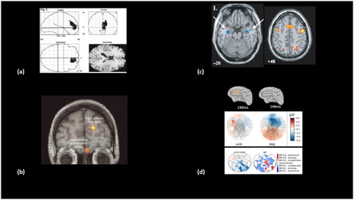 Figure 2. Role of ACC in voluntary and conscious triggering of involuntary cognitive processes in FND, in hypnotic induction and in active forgetting.Legend: According to our 5-stage model of FND, stage-3 would consist in GNW top-down control over specific cortical networks, and it is predicted to be a stage common to other conditions such as hypnotic induction and active voluntary forgetting. Several results support this prediction such as: (a) ACC activation during FND ‘palsy’ targets motor regions (Marshall et al. Cognition 1997); (b) ACC activation during Hypnotic ‘palsy’ targets motor regions (Halligan et al. Lancet 2000); (c) ACC activation during active forgetting targets hippocampi (Anderson et al. Science 2004) as an increase of activity in GNW areas including ACC associated to an inhibition of hippocampi areas; (d) ACC activation during Hypnotic ‘deafness’ targets conscious access to auditory cortices (Munoz-Musat et al. Front. in Neurol. 2022). Source estimation of high-density EEG revealed an ACC activation around 248ms post sound onset during the induced deafness condition (top left item), that was absent in the non-hypnotic condition (PRE condition, top right item). A proposed signature of conscious access (P3b ERP component) fully disappeared during induced deafness (middle figures), and right posterior sensors showed a strong decrease of functionally connectivity with other cortical areas during hypnotic deafness (bottom items; see Prediction 10 in the main text).