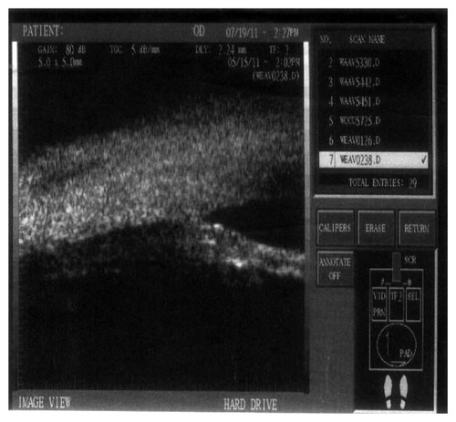 Figure 9 Ultrasonic biomicroscopy image for high reflectivity in a case of the control group (group C).