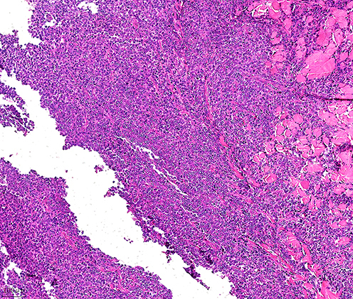 Figure 3 Histopathology of skin lesions: Diffuse infiltration of tumour cells in the dermis and subcutaneous tissues, with large tumour cells, abundant cytoplasm, round or irregular nuclei, obvious nucleoli, obvious heterotypes, obvious interstitial phenomenon, and focal infiltration of surrounding lymphocytes (HEx100).