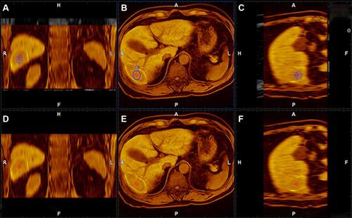 Figure 1 (A–C) After completing the fine adjustments, the lower row MRI images were finally overlapped to the upper row MRI images to create fusion images. In the successful and satisfactory fusion images, the relationship between the ablation zone and the tumor before IPTA in three dimensions was clearly observed. (D–F) The images after IPTA.