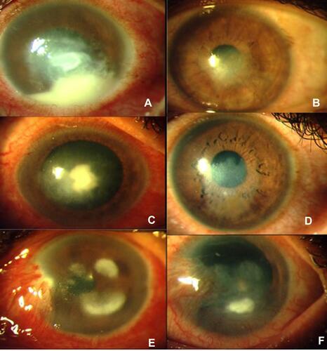 Figure 2 (A, C and E) Clinical photographs of recalcitrant fungal keratitis at day 0 in voriconazole, natamycin and amphotericin B groups, respectively. (B, D and F) Clinical photographs of cases (depicted in A, C and E) after healing in the voriconazole, natamycin and amphotericin B groups, respectively.