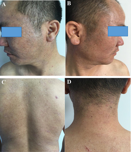 Figure 3 (A–D) Largely disappeared skin lesions on the back of the face and neck.
