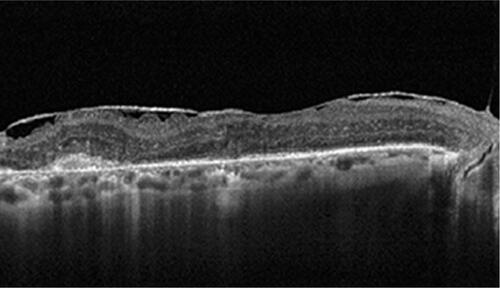 Figure S3 OCT image of an epiretinal membrane 90 days after intravitreal dexamethasone injection.Abbreviation: OCT, optical coherence tomography.