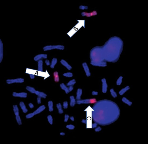 Figure 4 Whole chromosome 7 paint with red fluorescent probes. Arrow A shows the derivative chromosome 7. Arrow B shows the derivative chromosome 7 with the unlabeled part at the end indicating the translocated chromosomal material from the derivative chromosome 5. Arrow C shows the der(5) with translocated chromosomal material from der(7).