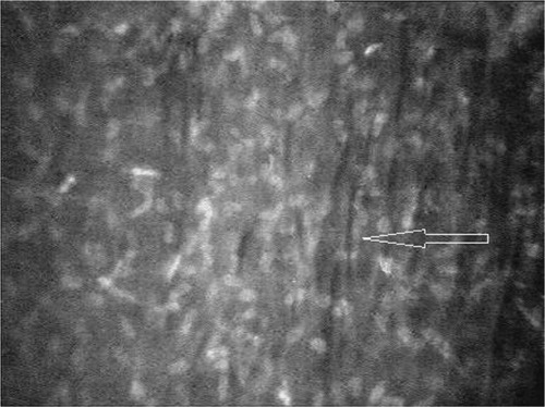 Figure 5 Thin dark bands (arrow) were observed in anterior stroma of the right eye in stage 3 keratoconus. Magnification 500× with 40× objective lens.