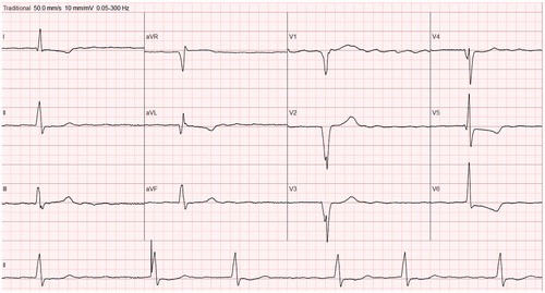 Figure 6. Twelve-lead ECG from a patient with HCM. Note pathological Q waves (leads V1–V4 and aVL), ST-depression and inverted T waves (leads I and V5–V6), somewhat wide QRS (121 ms) with notching (leads III, aVL, aVF, V2–V3). The patient has atrial fibrillation and an implanted pacemaker (see rhythm section in the lower part of the figure).