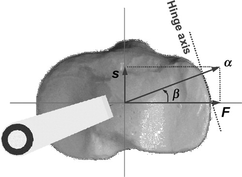 Figure 5. The wedge is internally rotated to correct complex deformities that consist of varus deformity in the frontal plane and recurvatum in the sagittal plane, where F is the necessary wedge size in the frontal plane for the correction of varus deformity and S the wedge size in the sagittal plane for the correction of recurvatum. The overall wedge size is α, while the necessary internal rotation angle is β.
