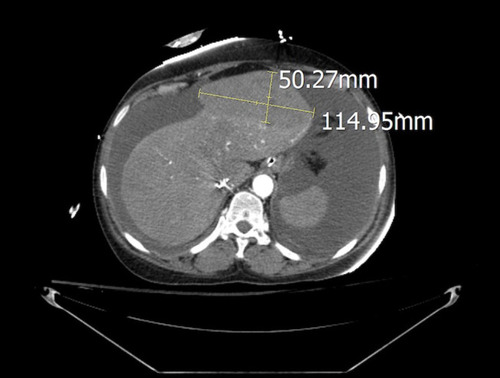 Figure 1 Contrast-enhanced CT scan showing left hepatic subcapsular hematoma (115 x 50 x 80 mm).