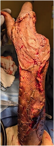 Figure 5. Split thickness skin graft placement.