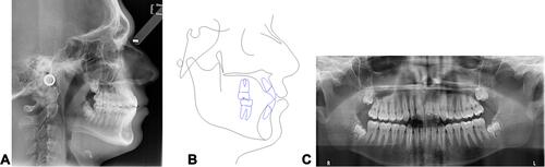 Figure 2 Clinical case 1: initial lateral head film (A), cephalometric tracing (B) and panorex (C).