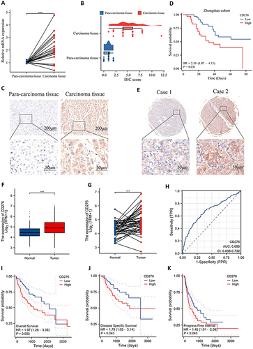 Figure 1 CD276 was upregulated in HCC and associated with poor prognosis. (A) Relative CD276 mRNA expression in HCC and para-carcinoma tissues of 20 patients. (B) Distribution and statistical analysis of CD276 IHC scores in tumor tissues and normal tissues. (C) Representative images of CD276 protein expression in HCC and para-carcinoma tissues. (D) The Kaplan–Meier survival analysis of overall survival in HCC patients from the Zhongshan cohort. (E) Representative images of CD276 protein expression in HCC tissues. (F) mRNA levels of CD276 in HCC compared with those in normal cells. (G) CD276 mRNA expression in tumor tissue and normal tissues from 50 HCC patients form TCGA database. (H) Diagnostic power of CD276 in HCC patients. (I–K) The Kaplan–Meier analysis of overall survival, progression free survival and progression free interval in HCC patients form TCGA database.