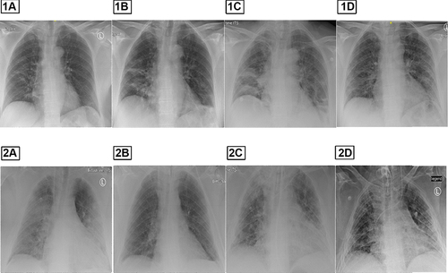 Figure 1 Chest X-Ray by Patient 1(1A–D) and Patient 2(2A–D). (1A) On admission, (1B) Control after 3 days, (1C) Control on the day 1 at ICU (12 hours after 1B), (1D) Control after treatment. (2A) On admission, (2B) Control on day 8, (2C) Control on day 35 during antibiotic and antifungal Therapy, (2D) After treatment.