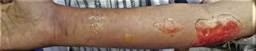 Figure 1. Blisters and ulcers due to parenteral injection of chlorpyrifos.