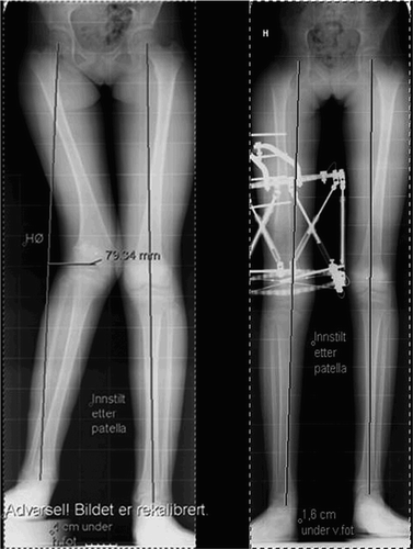 Figure 6. After the correction with the Taylor Spatial Frame (right panel). The patient was overcorrected in length according to loss of the remaining growth (15 mm) in the affected physis after completion of the epiphysiodesis.