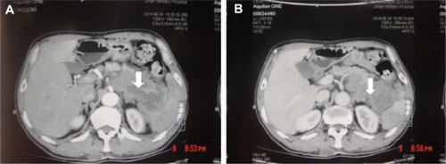 Figure 5 (A, B) A CT scan showing diffuse hypodense enlargement of the pancreatic tail (arrow).