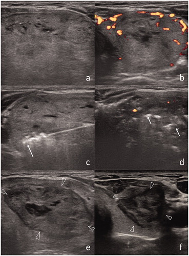 Figure 3. (a) US representation of a benign thyroid nodule (6.4 × 4.0 × 2.8 cm) in the left thyroid lobe. (b) Prominent vascularization is confirmed at Doppler US. (c) RF applicator with 1 cm size active tip is introduced within the nodule (arrow). (d) Post-procedural US shows decreased vascularization in nodule and air bubbles as hyperechoic areas (arrows). (e) After 1 month, the size of nodule is decreased (2.2 × 3.7 × 4.5 cm). (f) Further dimensional reduction after 1 year (1.3 × 1.4 × 2.4 cm).