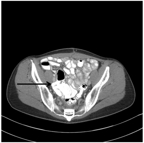 Figure 9. CT slice showing pelvic sidewall invasion. A patient with peritoneal mucinous carcinoma of appendiceal origin underwent pelvic lymphadenectomy and tumour reseeded on the right pelvic sidewall. At her first surgery she was thought to have ovarian cancer.
